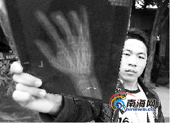 男子工作被切手指 老板拒赔称其他工人会效仿