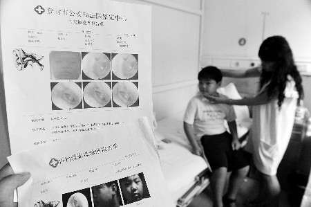 河南一男童被少林夏令营教官殴打 左耳鼓膜穿孔