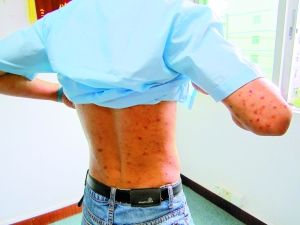 深圳多家工厂舍臭虫遍地 工人被咬上百伤疤(图)